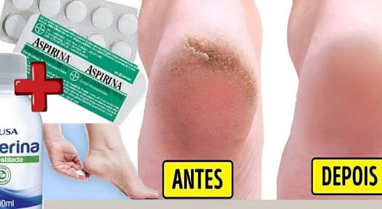 Hidratante Caseiro Para Pés Rachados