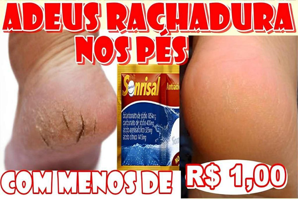 como acabar com as rachaduras dos pés