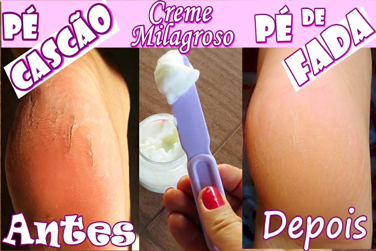 Creme caseiro para pés rachados que vai deixar os seus pés muito macios ...