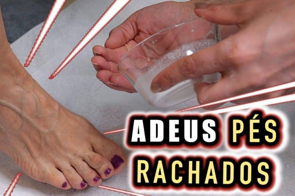 Como Acabar Com As Rachaduras Nos Pés