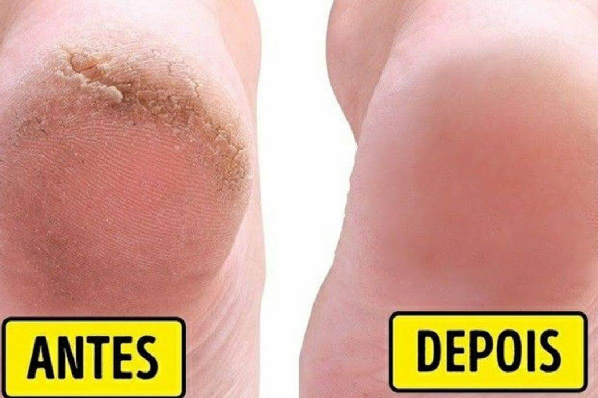 Dica para pés rachados e ressecados ficarem lisinhos parecendo pezinho ...