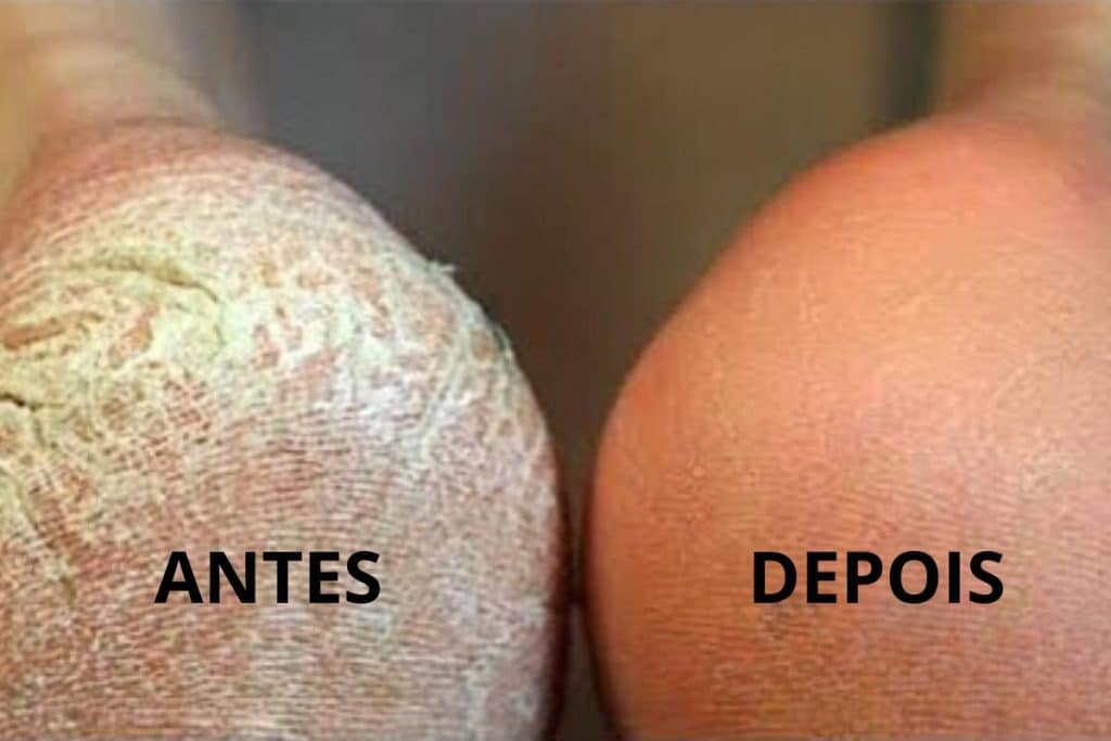 Dica Para Pés Ressecados