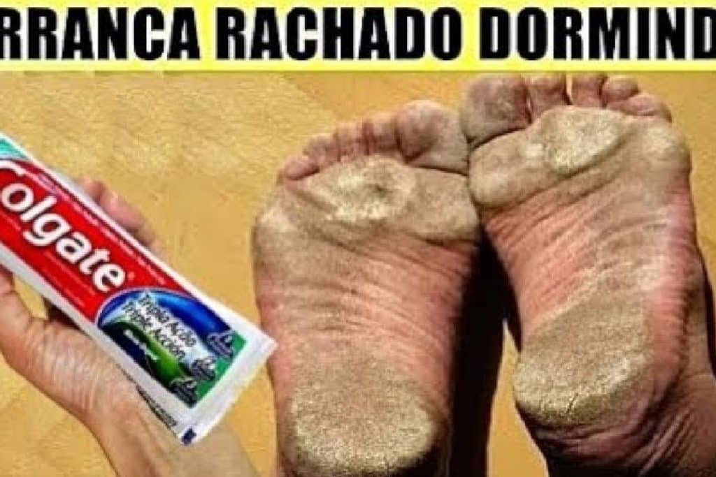 Como Tirar Rachadura Dos Pés