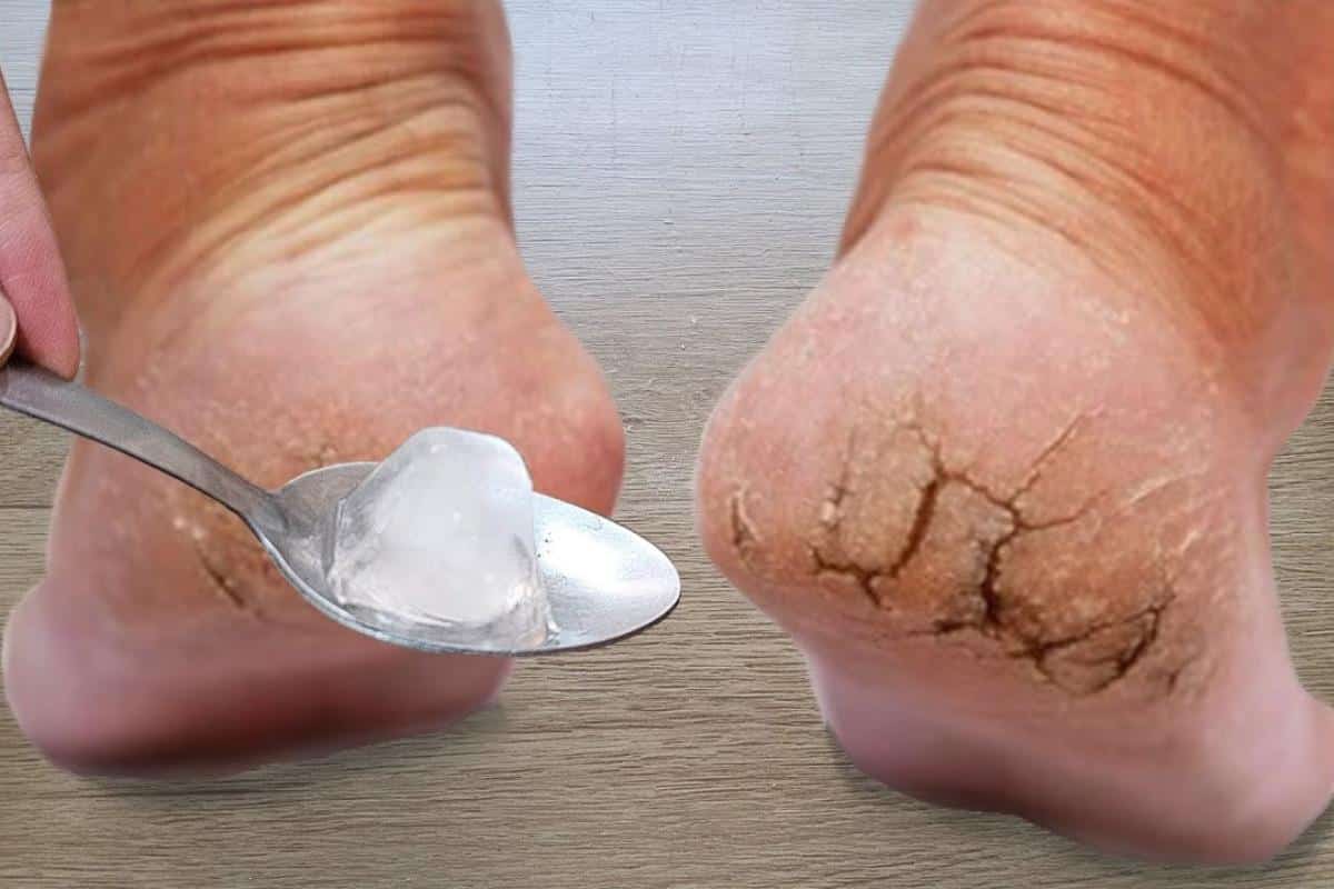 Como tirar rachaduras dos pés: segredo de podóloga profissional para ...