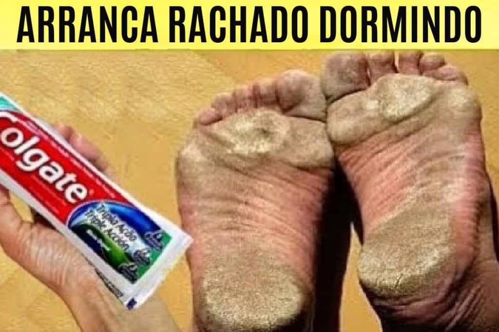 Como Tirar Rachaduras Dos Pés