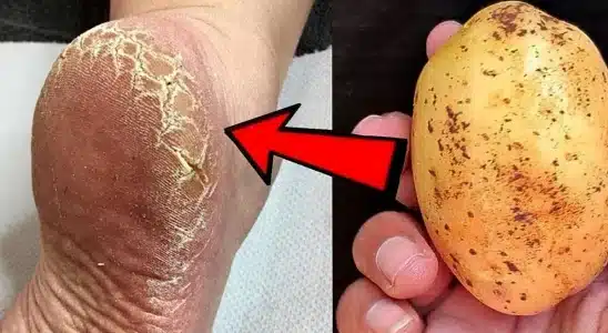 Como acabar com rachaduras dos pés: dica muito prática que aprendi com uma podóloga 4 como acabar com rachaduras dos pés