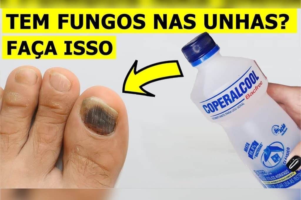 como eliminar fungos das unhas 0603