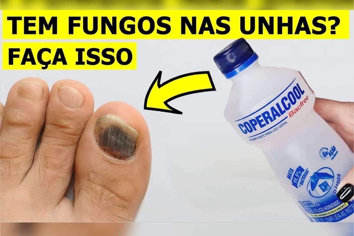 como eliminar fungos das unhas 0603