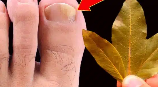Como tirar micose da unha: segredo que uma podóloga me ensinou sem cobrar nada 4 como tirar micose da unha