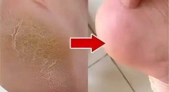 Dica caseira para pés rachados e ressecados: fica lisinho igual pezinhos de bebê 3 dica caseira para pés rachados