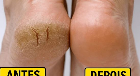 como tirar rachadura dos pés