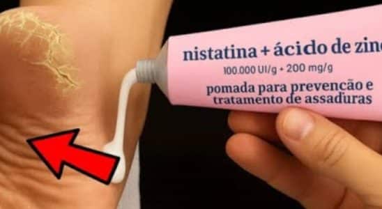 como tirar rachaduras dos pés