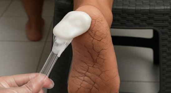 creme caseiro para rachaduras