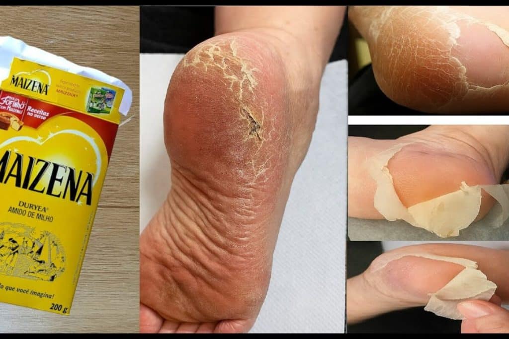 como tirar rachaduras dos pés