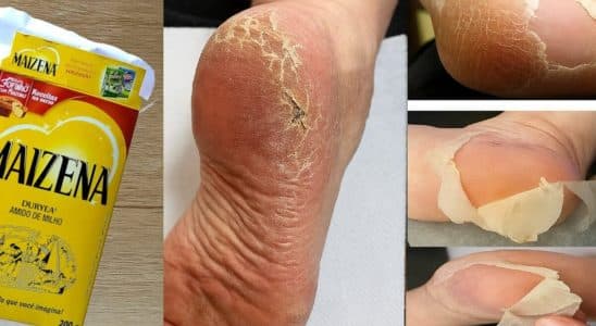 como tirar rachaduras dos pés