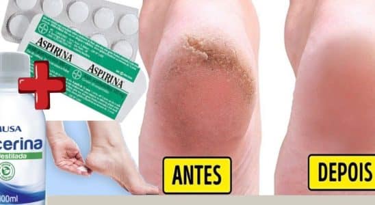 hidratante caseiro para pés rachados