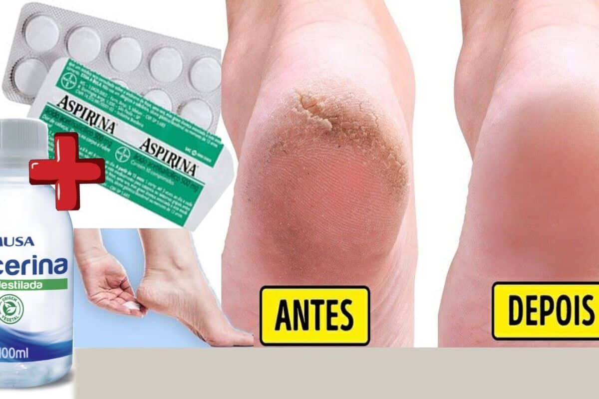 Hidratante caseiro para pés rachados que deixa a pele lisinha