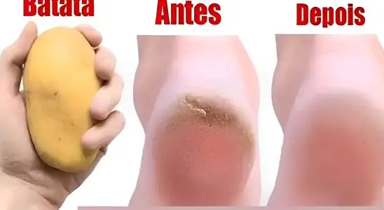 Depois que você aprender como deixar seus pés lisos sua vida vai ficar muito fácil 1 como deixar seus pes lisos 27 071