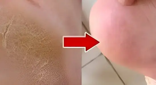 Dica para acabar com as rachaduras nos pés que deixa os pés lisinhos desde a primeira aplicação 3 dica para acabar os rachados do pé