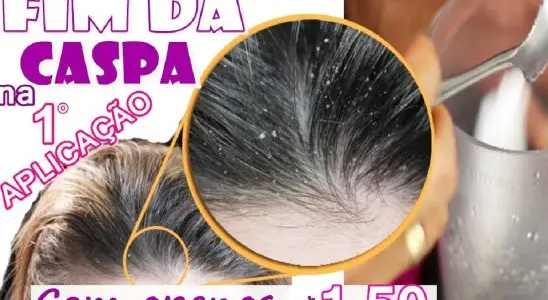 Como acabar com a caspa sem precisar comprar shampoo caro 4 como acabar as caspas