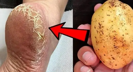 Como acabar com as rachaduras dos pés de um jeito surpreendente sem precisar comprar cosmético caro 3 como acabar com as rachaduras dos pés