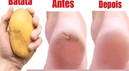 Você não vai acreditar nessa dica de como deixar seus pés lisos e sem rachaduras nos calcanhares 4 como deixar seus pés lisos