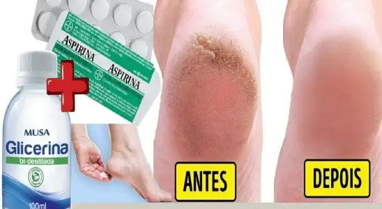 Hidratante caseiro que vai deixar seus pés lisinhos parecendo pé de bebê 1 hidratante caseiro