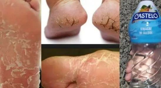 Seus problemas com pés rachados está com os dias contados com essa dica 1 pés rachados